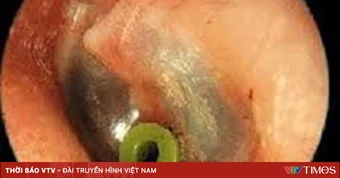Viêm tai giữa ứ dịch - mối đe doạ thính lực và ngôn ngữ của trẻ