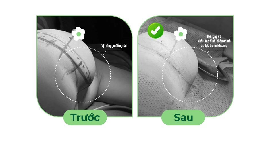 Vỡ túi ngực âm thầm chị em cần lưu ý Vỡ túi ngực âm thầm chị em cần lưu ý