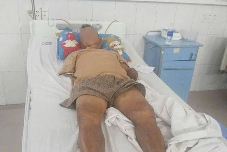 Vụ ông lão cụt tay kẹp rắn sau khi bị cắn: Bệnh nhân đã qua nguy kịch Vụ ông lão cụt tay kẹp rắn sau khi bị cắn: Bệnh nhân đã qua nguy kịch