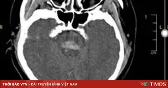 Xuất huyết não vì bỏ thuốc huyết áp