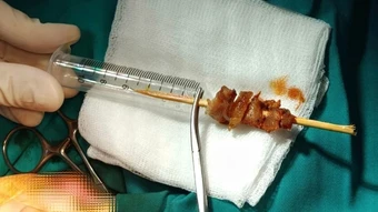 Xuyên đêm cứu bé gái 2,5 tuổi bị que xiên thịt đâm sát não