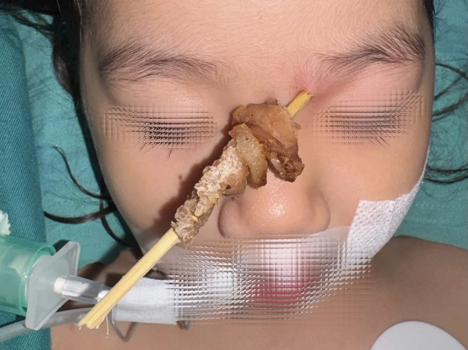 Xuyên đêm cứu bé gái 2,5 tuổi bị que xiên thịt đâm sát não Xuyên đêm cứu bé gái 2,5 tuổi bị que xiên thịt đâm sát não