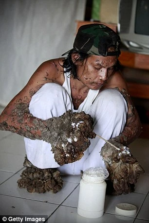 42 năm cuộc đời đầy bi kịch của người cây