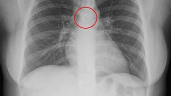 Ho kéo dài, người phụ nữ phát hiện khuyên mũi mắc kẹt trong phổi
