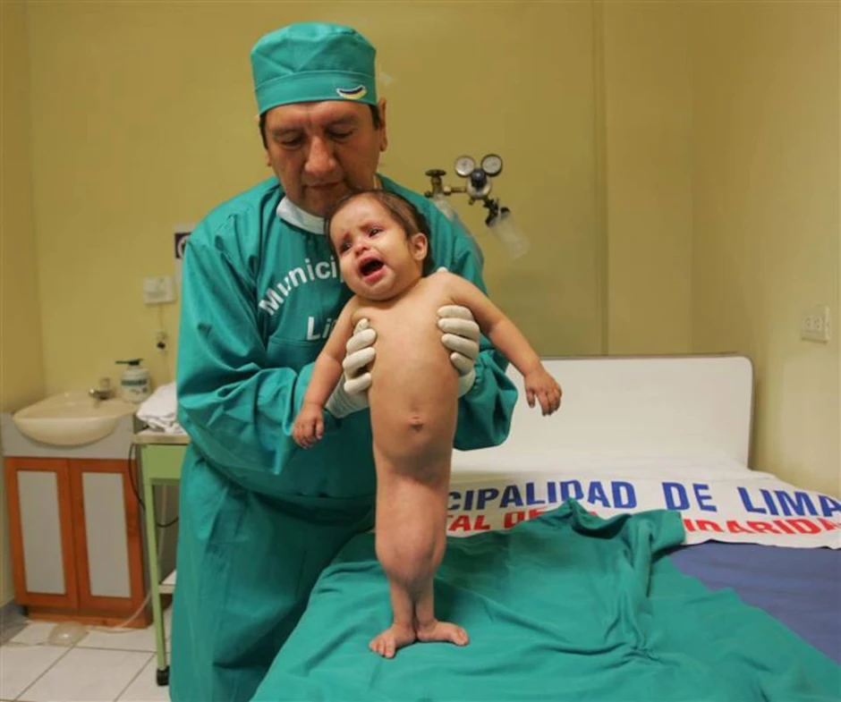 Nàng tiên cá ngoài đời thực: Bé gái chào đời với đôi chân dính liền và 15 năm sống năm phi thường như "một kỳ tích y học" Nàng tiên cá ngoài đời thực: Bé gái chào đời với đôi chân dính liền và 15 năm sống năm phi thường như "một kỳ tích y học"