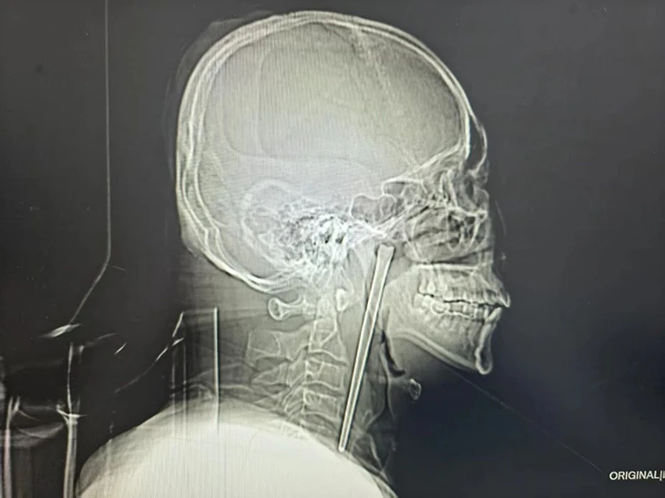 Người đàn ông sống tám năm với đũa kim loại dài 12cm mắc trong cổ họng Người đàn ông sống tám năm với đũa kim loại dài 12cm mắc trong cổ họng