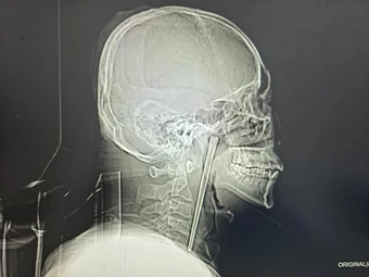 Người đàn ông sống tám năm với đũa kim loại dài 12cm mắc trong cổ họng
