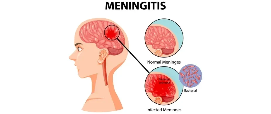 Anh ghi nhận ổ dịch viêm màng não hiếm gặp khiến 2 người tử vong Anh ghi nhận ổ dịch viêm màng não hiếm gặp khiến 2 người tử vong