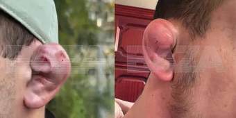 Đàn ông Nga gây sốc với trào lưu làm tai 'súp lơ' để trông đáng sợ hơn