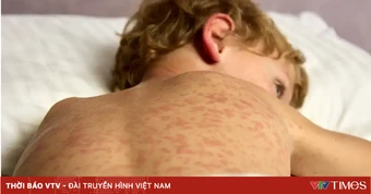 Dịch sởi bùng phát tại Mỹ
