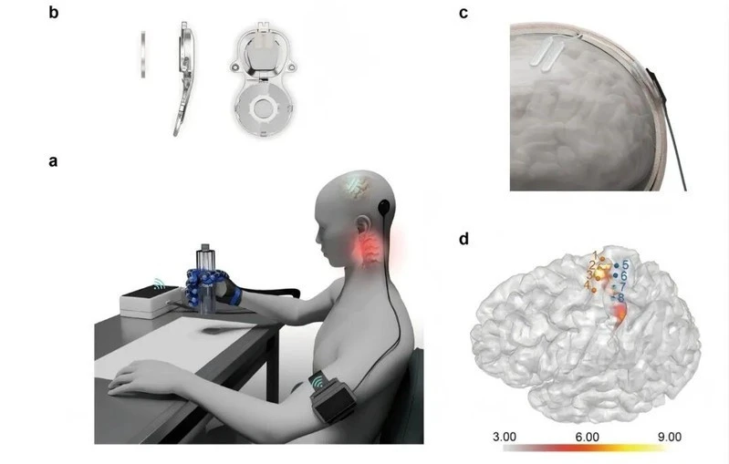 Đột phá công nghệ NEO và Neuralink: Người liệt cử động tay chân, ‘Sọ Dừa’ điều khiển máy tính chỉ bằng ý nghĩ Đột phá công nghệ NEO và Neuralink: Người liệt cử động tay chân, ‘Sọ Dừa’ điều khiển máy tính chỉ bằng ý nghĩ