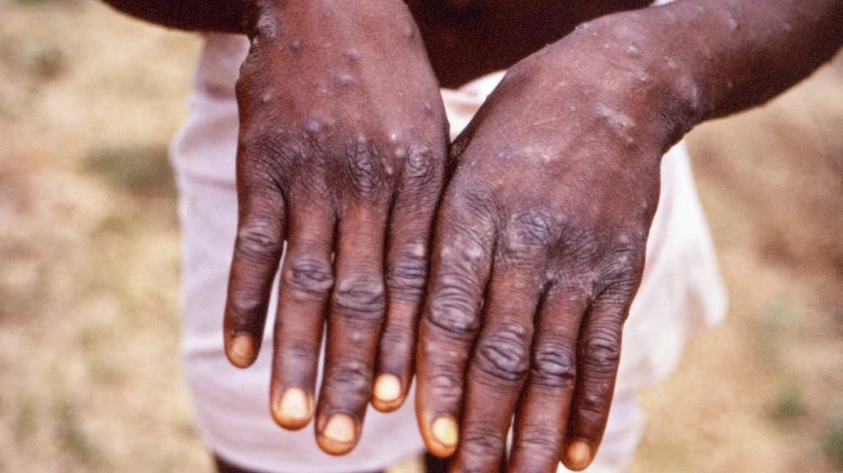 Guinea-Bissau đối mặt với đợt bùng phát bệnh đậu mùa khỉ Guinea-Bissau đối mặt với đợt bùng phát bệnh đậu mùa khỉ