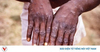 Guinea-Bissau đối mặt với đợt bùng phát bệnh đậu mùa khỉ