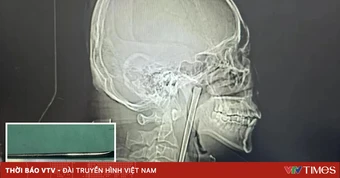 Hy hữu người đàn ông Trung Quốc sống 8 năm với chiếc đũa kim loại mắc trong cổ họng