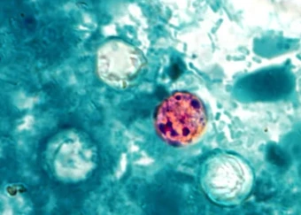 Ký sinh trùng Cyclospora là gì và vì sao đang gây lo ngại tại Mỹ?
