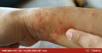 Số ca tử vong tăng, Thái Lan cảnh báo bùng phát dịch “sốt đất” nguy hiểm