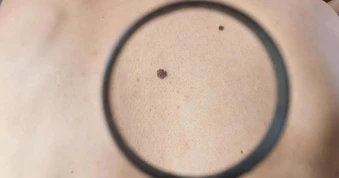 Thuốc trị ung thư bằng công nghệ mRNA đạt đột phá trong thử nghiệm lâm sàng