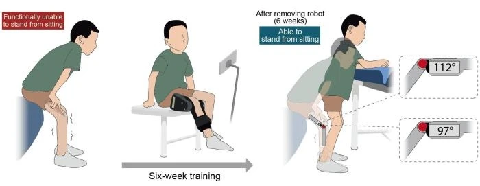 Trung Quốc phát triển robot đeo hỗ trợ trẻ mắc teo cơ tủy sống phục hồi vận động Trung Quốc phát triển robot đeo hỗ trợ trẻ mắc teo cơ tủy sống phục hồi vận động
