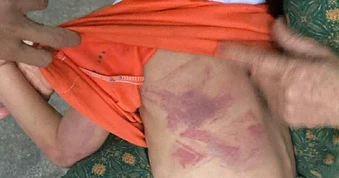 Bé gái lớp 2 bị bạn nam cùng lớp dùng thước nhựa dẻo đánh thâm tím người vì không cho kẹo