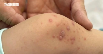 Bệnh tay chân miệng tăng cao: Vắc xin vẫn chờ công bố  giá