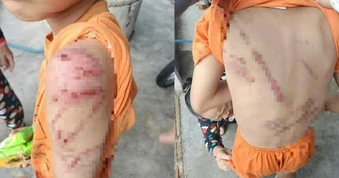 Cha đánh con 10 tuổi bầm tím khắp người vì bỏ học và đập điện thọai