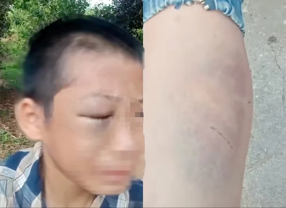 Clip bé trai mắt bầm tím kêu cứu vì bị đánh đập gây Xôn xao Mạng xã hội Clip bé trai mắt bầm tím kêu cứu vì bị đánh đập gây Xôn xao Mạng xã hội