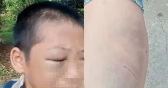 Clip bé trai mắt bầm tím kêu cứu vì bị đánh đập gây Xôn xao Mạng xã hội