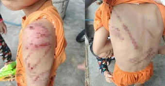 Lý do người cha đánh con 10 tuổi bầm tím khắp người