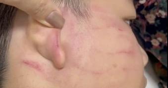 Thầy giáo người Ấn Độ tát học sinh thủng màng nhĩ: Gia đình chưa yêu cầu xử lý hình sự