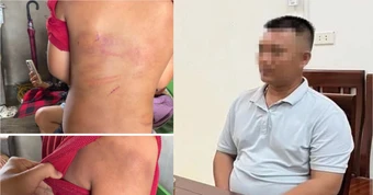 Vụ bé trai 10 tuổi người thâm tím nghi bị bạo hành: Lời khai của bố đẻ
