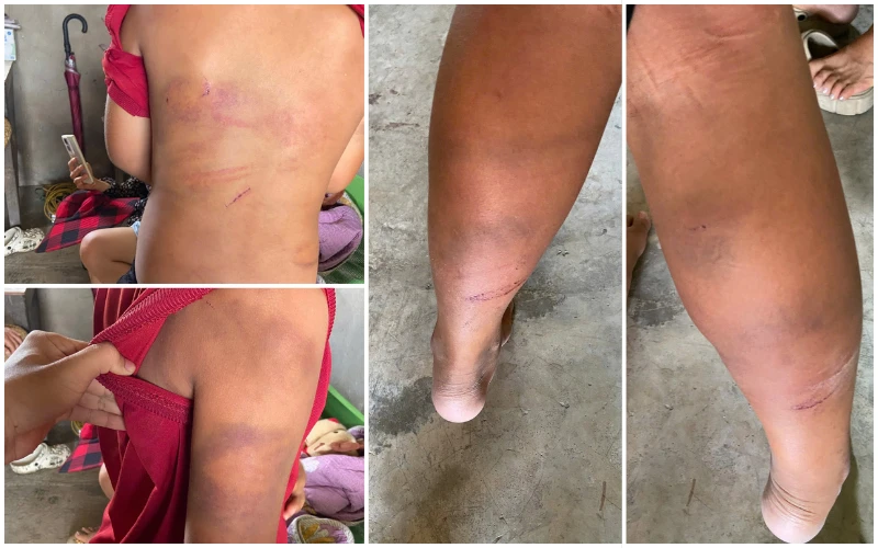 Vụ bé trai 10 tuổi người thâm tím nghi bị bạo hành: Lời khai của bố đẻ Vụ bé trai 10 tuổi người thâm tím nghi bị bạo hành: Lời khai của bố đẻ