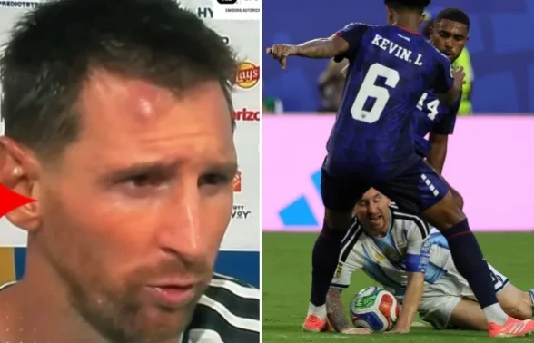 Lionel Messi và vết sưng trên trán sau trận thắng Cape Verde Lionel Messi và vết sưng trên trán sau trận thắng Cape Verde