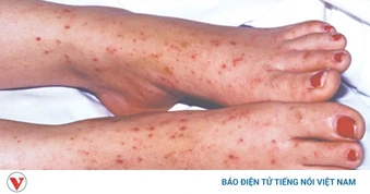 4 ca tử vong, 24 trường hợp mắc não mô cầu, Bộ Y tế cảnh báo dịch