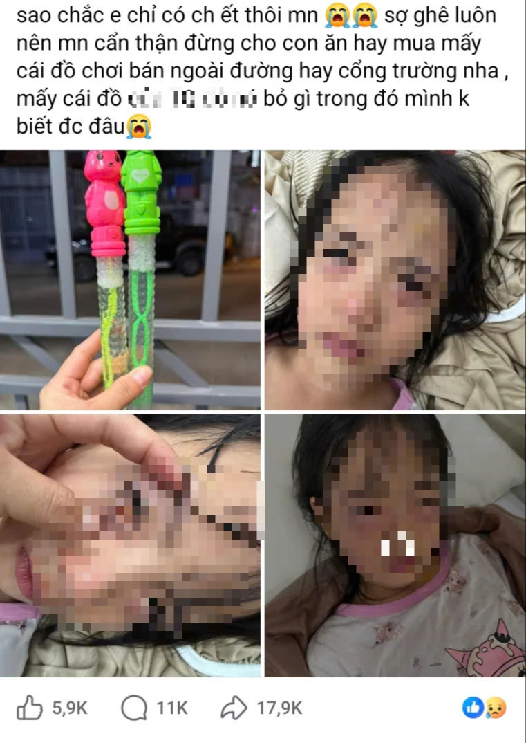 Bé gái 5 tuổi tổn thương mắt sau khi thổi bong bóng xà phòng Bé gái 5 tuổi tổn thương mắt sau khi thổi bong bóng xà phòng