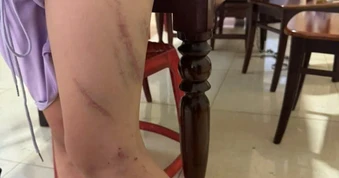 Bé gái 9 tuổi chi chít vết bầm trên cơ thể, nghi bị mẹ bạo hành