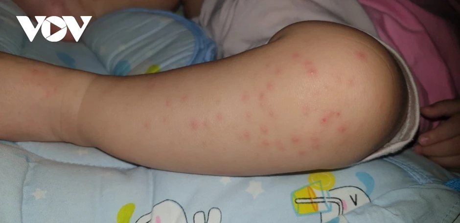 Bệnh tay chân miệng gia tăng, nhiều trẻ nhập viện trong tình trạng nặng tại TP.HCM Bệnh tay chân miệng gia tăng, nhiều trẻ nhập viện trong tình trạng nặng tại TP.HCM