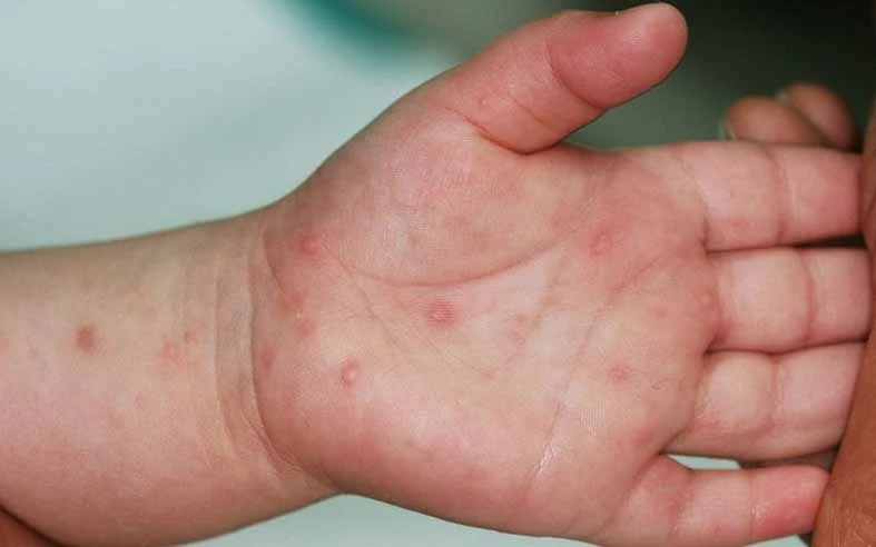 Bệnh tay chân miệng tăng 5 lần, Bộ Y tế hoả tốc yêu cầu ứng phó Bệnh tay chân miệng tăng 5 lần, Bộ Y tế hoả tốc yêu cầu ứng phó