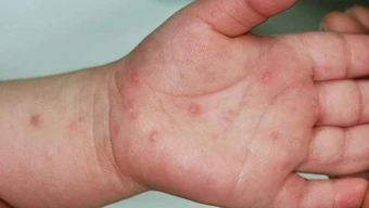 Bệnh tay chân miệng tăng 5 lần, Bộ Y tế hoả tốc yêu cầu ứng phó