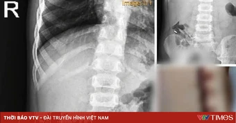 Bệnh viện Sản Nhi Nghệ An làm rõ phản ánh liên quan bệnh nhi nuốt nam châm
