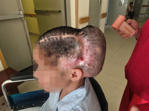 Biến chứng kinh hoàng sau cấy mỡ thái dương: Một phụ nữ suýt mất mạng vì đột quỵ Biến chứng kinh hoàng sau cấy mỡ thái dương: Một phụ nữ suýt mất mạng vì đột quỵ