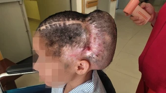 Biến chứng kinh hoàng sau cấy mỡ thái dương: Một phụ nữ suýt mất mạng vì đột quỵ