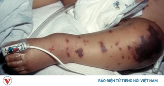 Bộ Y tế yêu cầu không để dịch bệnh viêm màng não mô cầu lan rộng tại cộng đồng