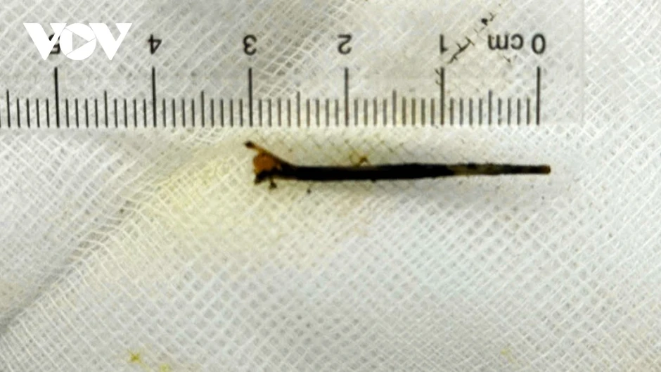 Cần Thơ: Hy hữu xương cá 3cm xuyên vào đường mật Cần Thơ: Hy hữu xương cá 3cm xuyên vào đường mật
