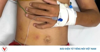 Cứu sống bé trai bị ong vò vẽ đốt 55 vết trong lúc đi rừng