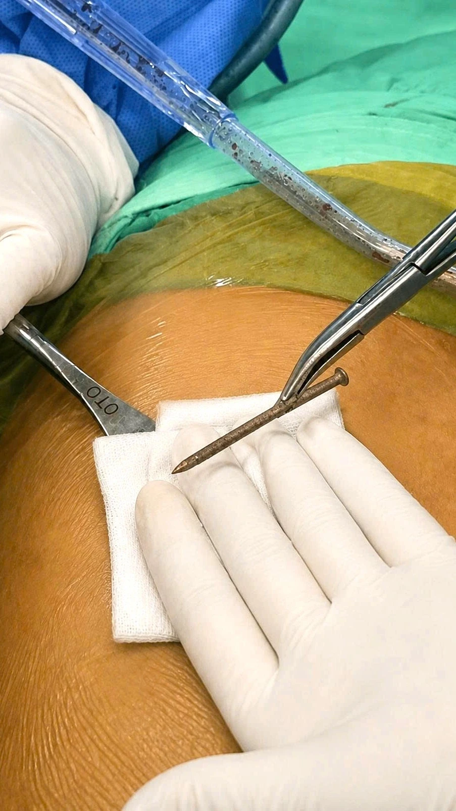Cứu sống bệnh nhân bị đinh kim loại xuyên thành bụng ở Cần Thơ