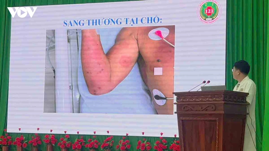 Cứu sống bệnh nhân bị ong vò vẽ đốt 150 vết Cứu sống bệnh nhân bị ong vò vẽ đốt 150 vết
