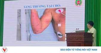 Cứu sống bệnh nhân bị ong vò vẽ đốt 150 vết
