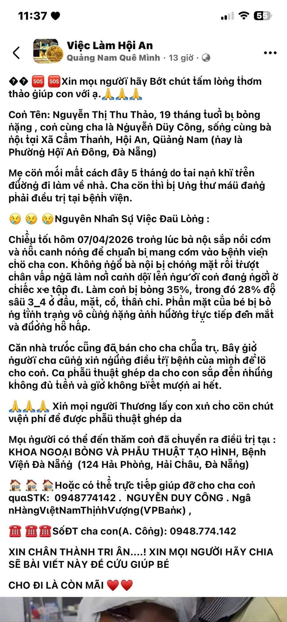 Dựng việc con gái 19 tháng tuổi bị bỏng nặng để lừa đảo kêu gọi từ thiện Dựng việc con gái 19 tháng tuổi bị bỏng nặng để lừa đảo kêu gọi từ thiện