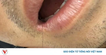 Hy hữu: Nhập viện cấp cứu vì lưỡi câu nằm ngang thực quản sau khi ăn cá