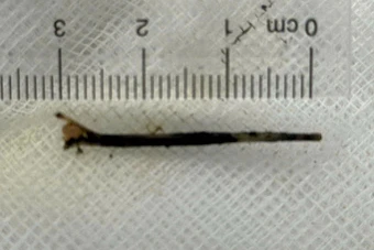 Hy hữu: Xương cá dài 3cm đâm xuyên đường mật